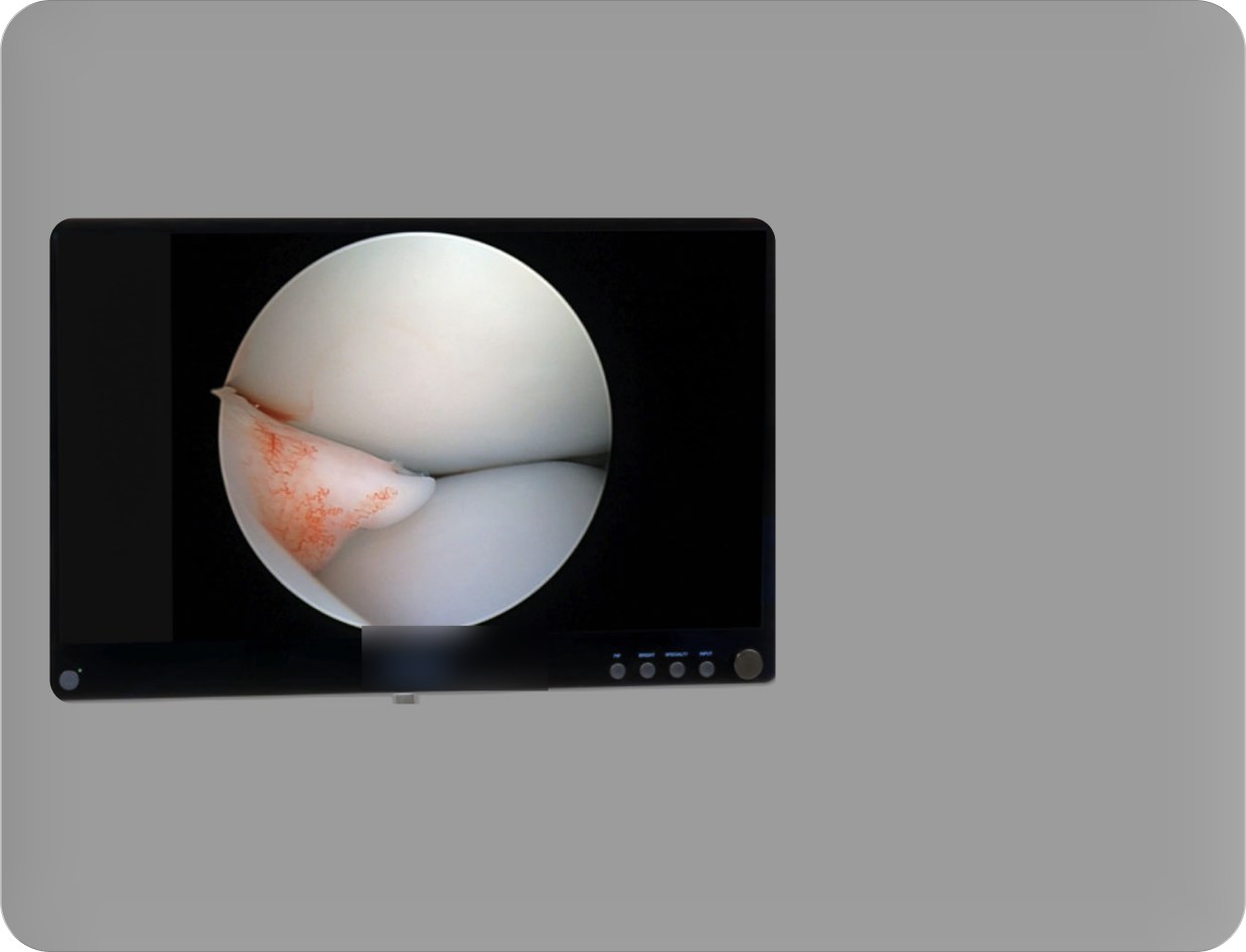 Arthroscopic OR monitor showing a surgical view